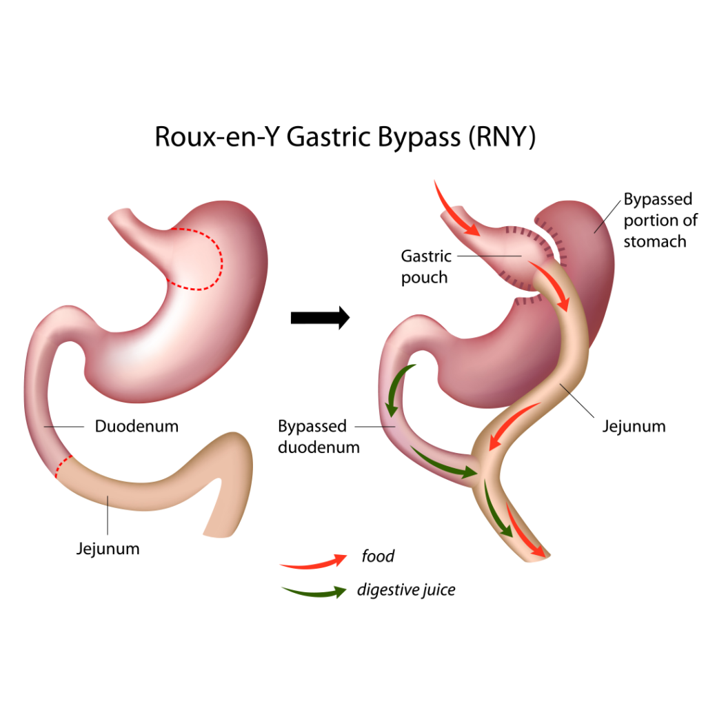 gastric bypass diagram, roux-en-y