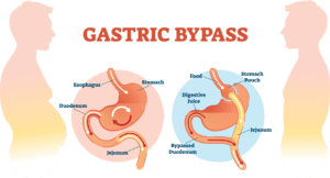 Illustration showing how the stomach works before and after a gastric bypass